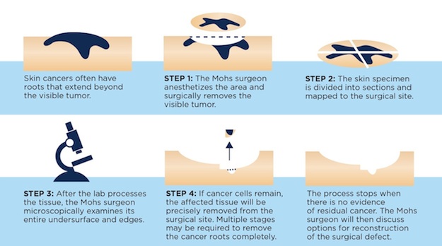 Mohs Illustration