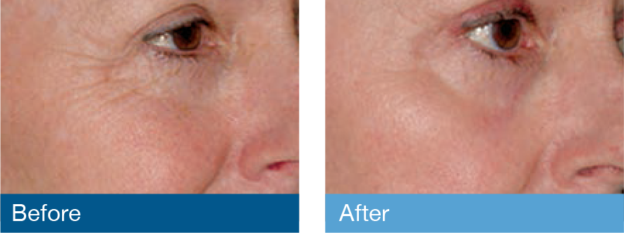 Fraxel Laser Treatments