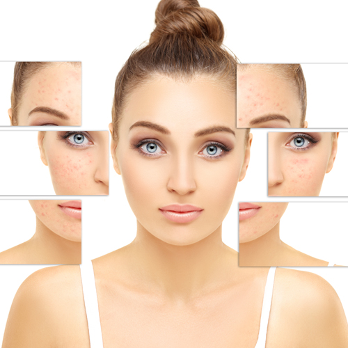 5 causes of acne and pimples