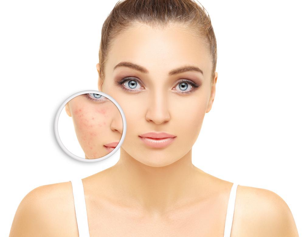 acne causes