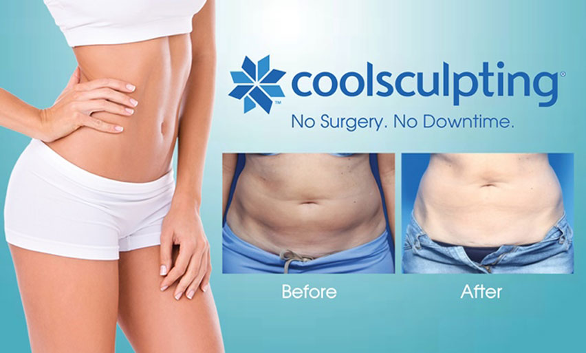Coolsculpting Results - Before and After