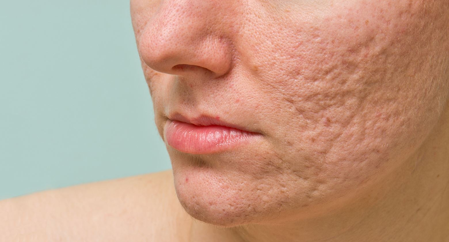 how to get rid of acne scars