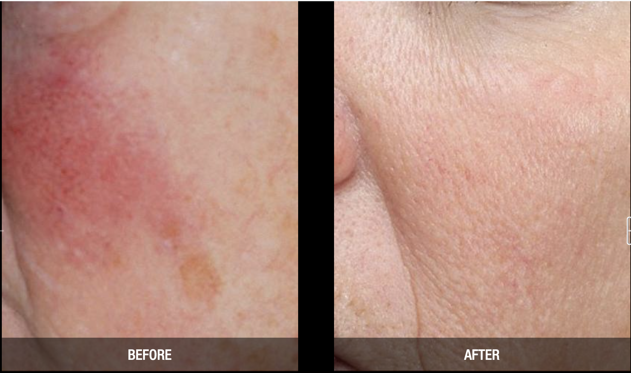 vbeam before after