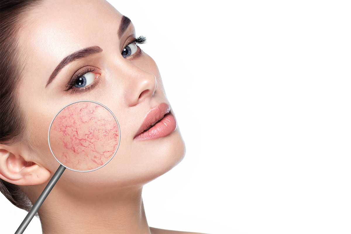VBeam laser treatment for rosacea