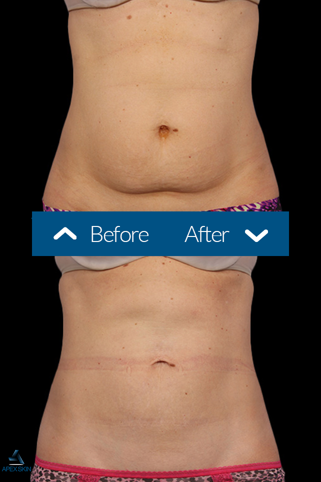 Coolsculpting Results - Before and After