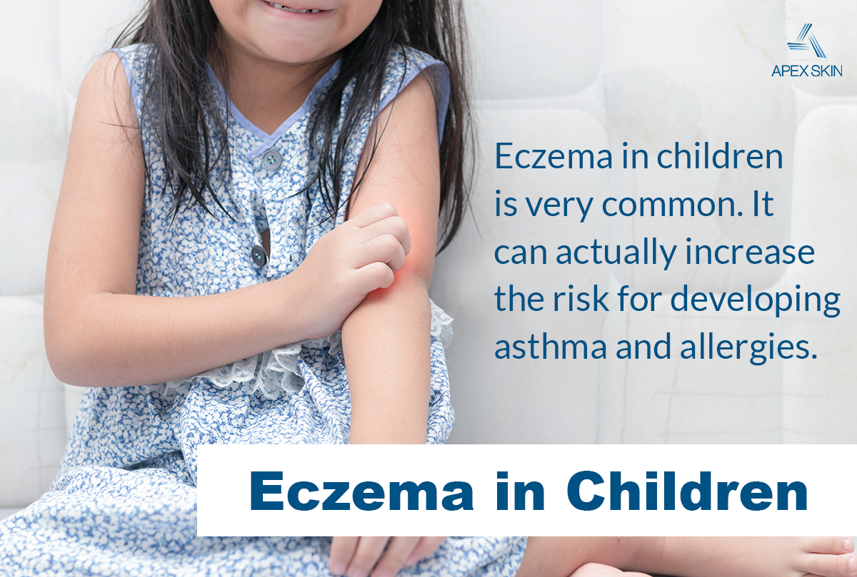 eczema in children