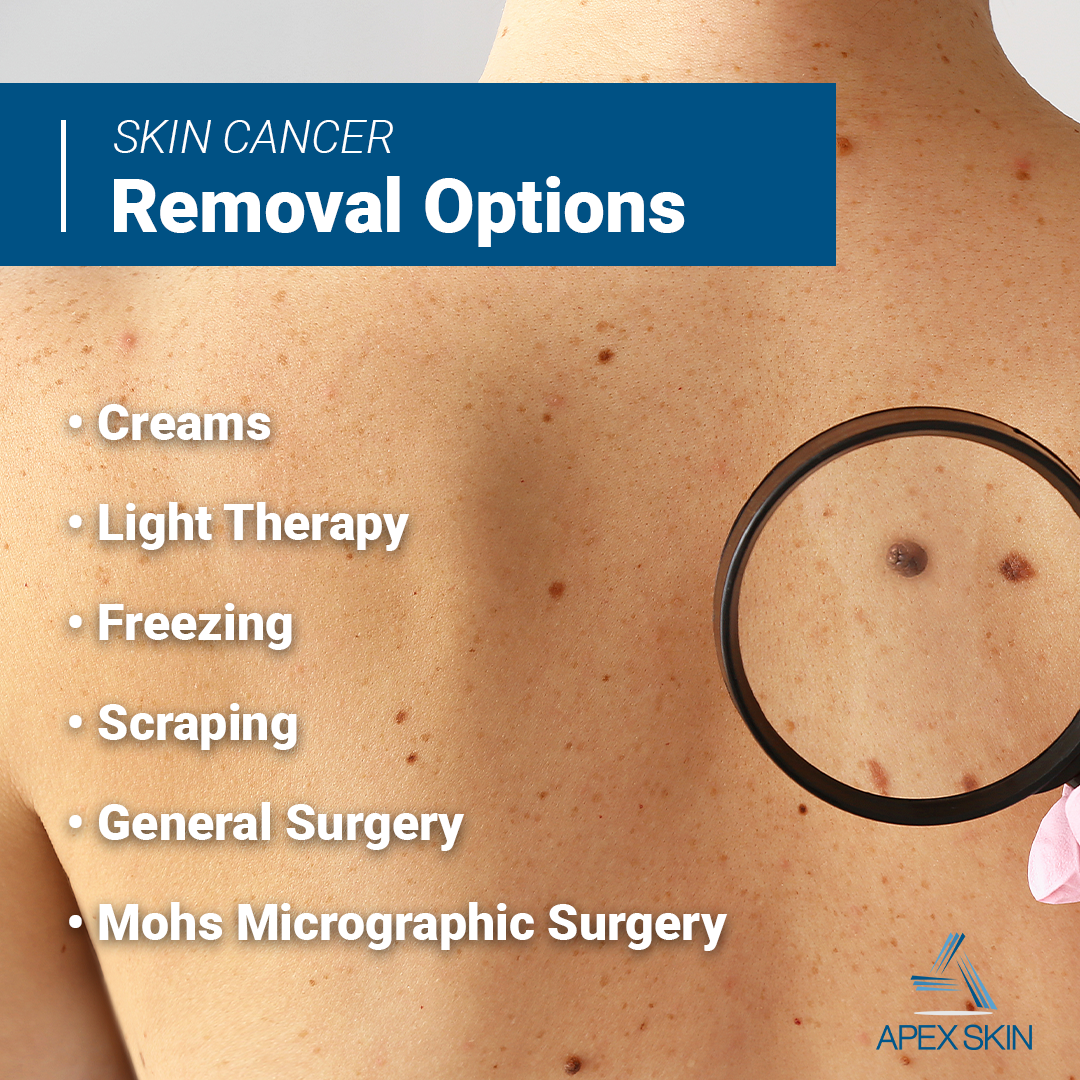 skin cancer removal