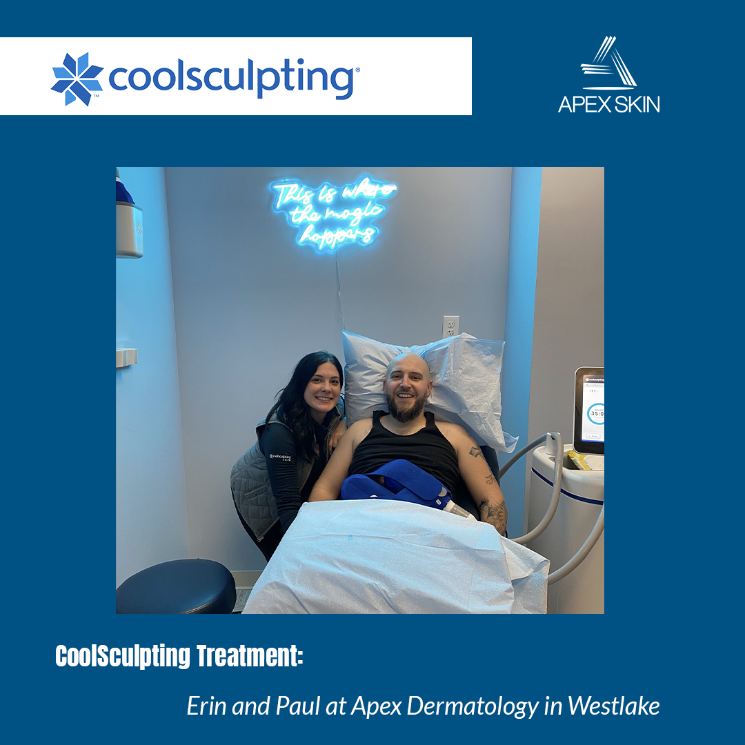 coolsculpting treatment