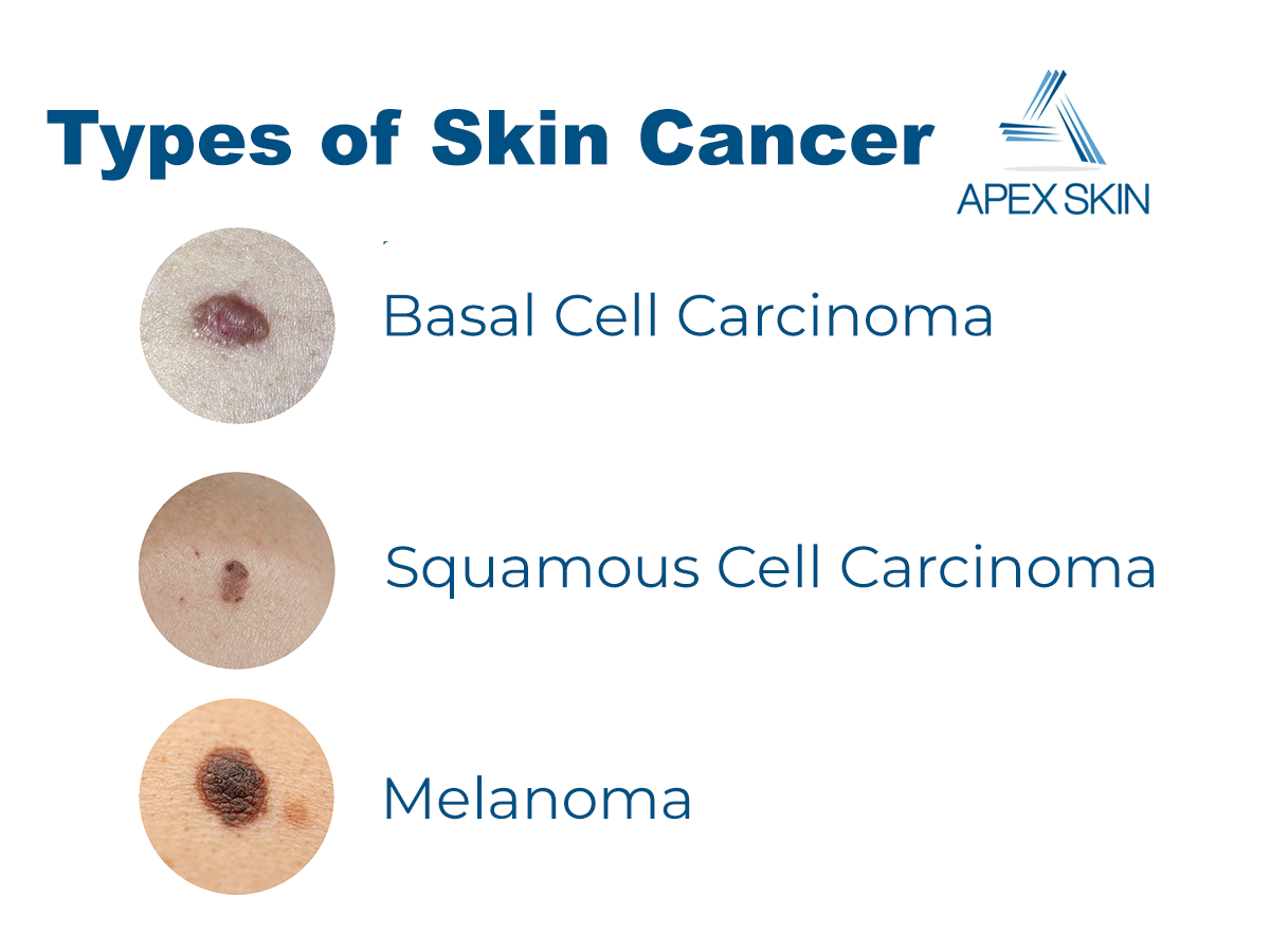 types of skin cancer