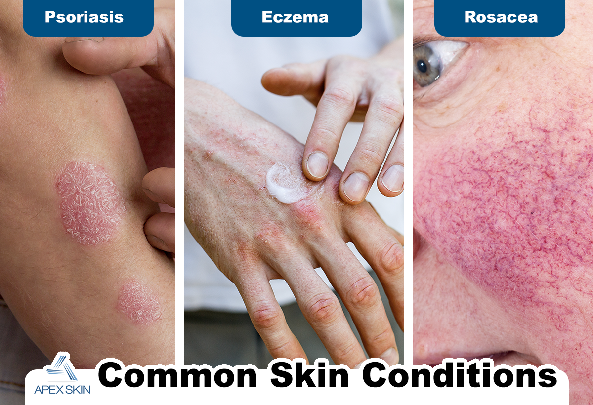 common skin conditions - Psoriasis, Eczema Rosacea