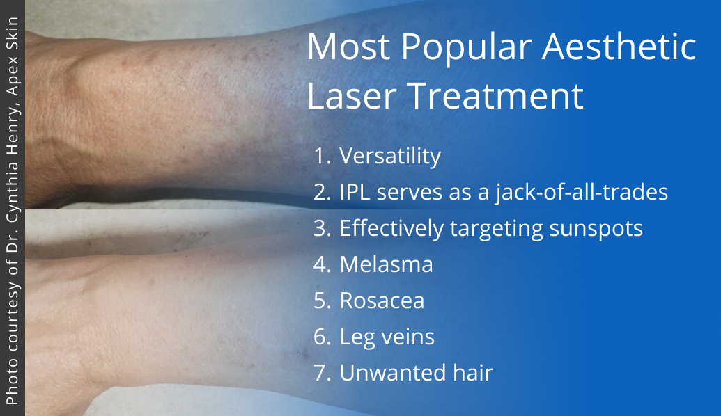 results from IPL treatment on arm