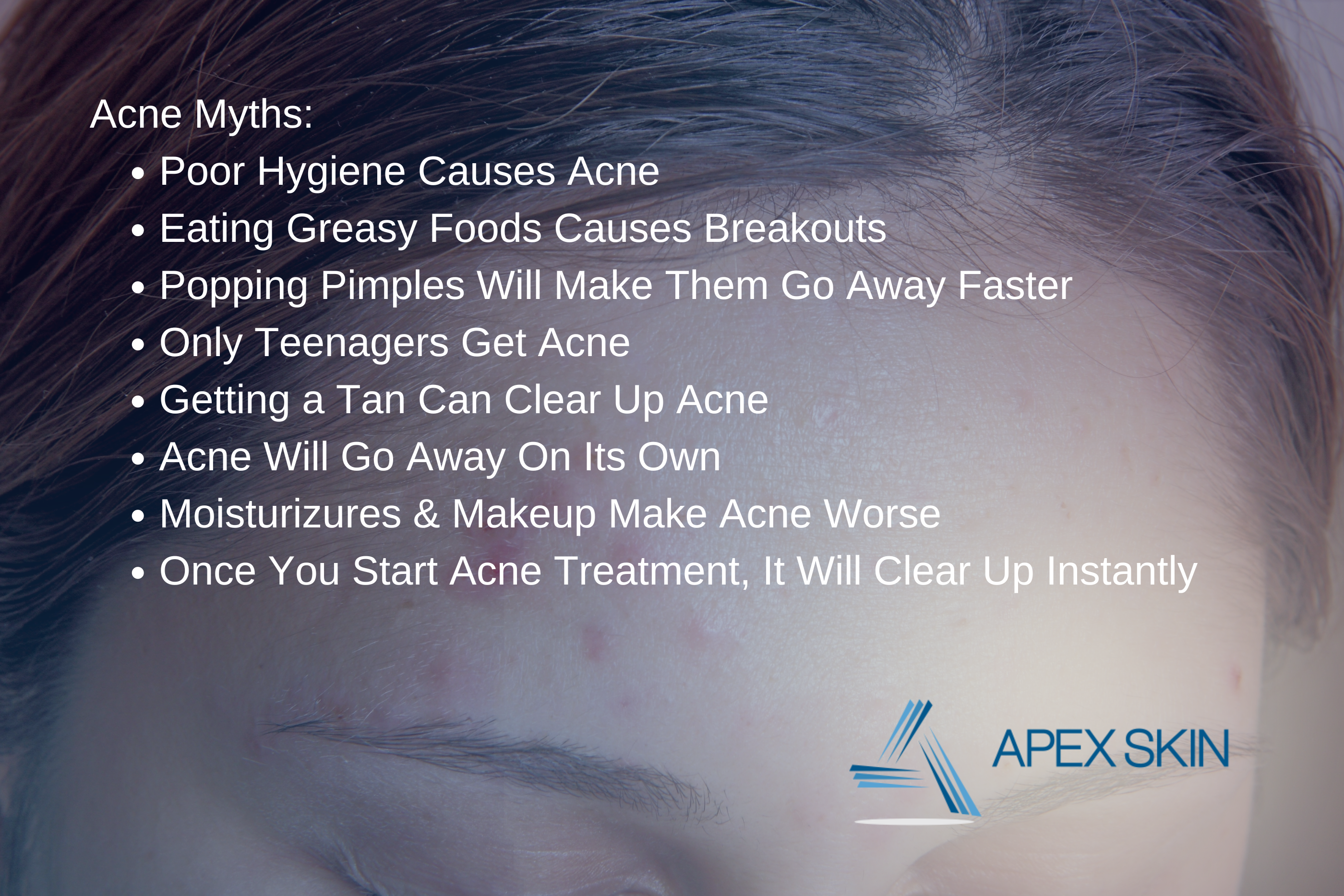 Acne myths