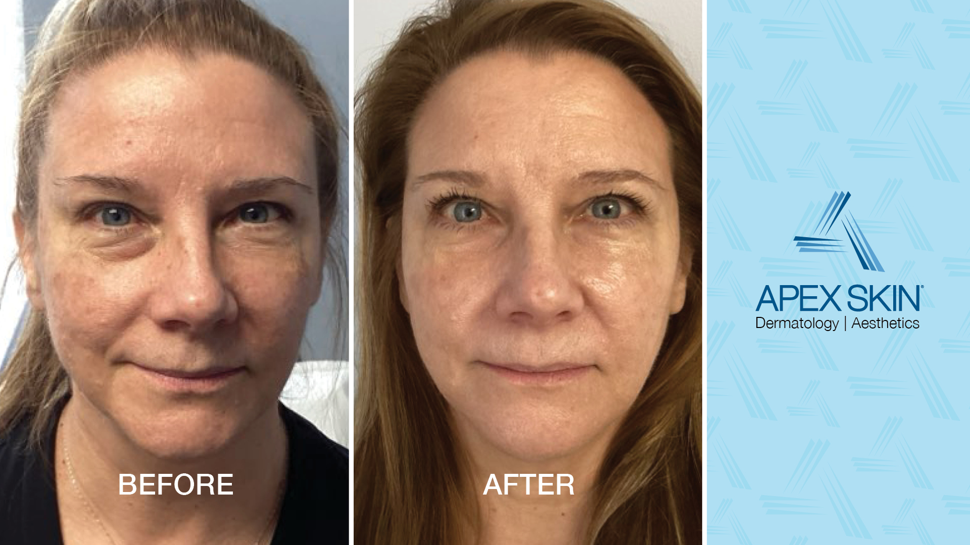 Skin Laser Treatment Before and After