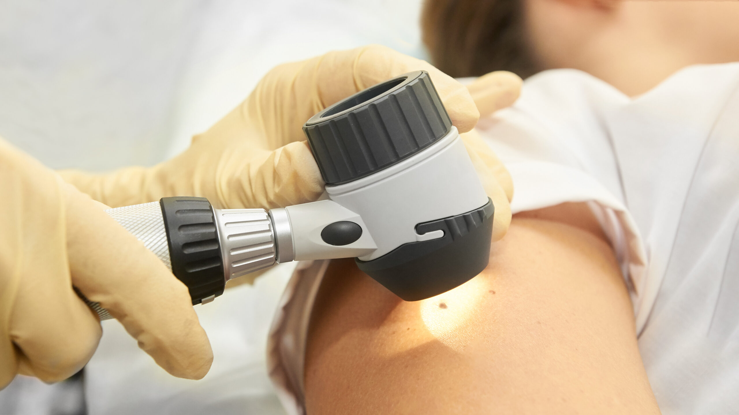 melanoma testing