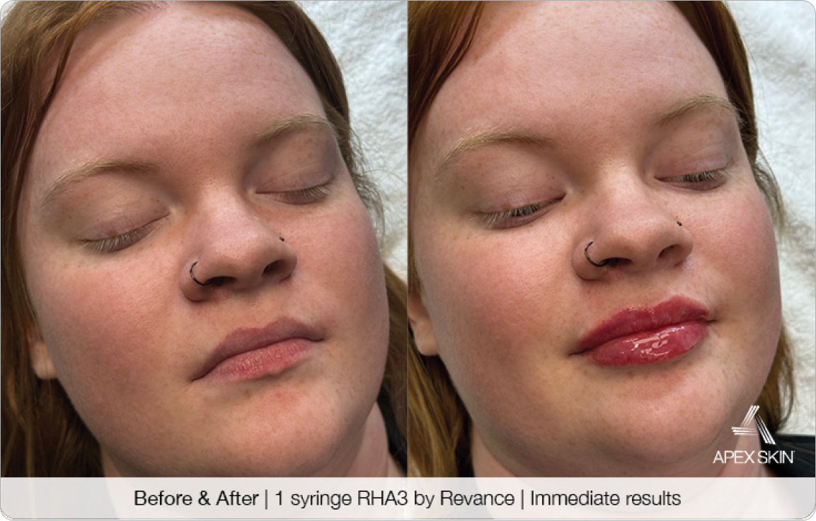 Revance RHA3 Filler - Before & After