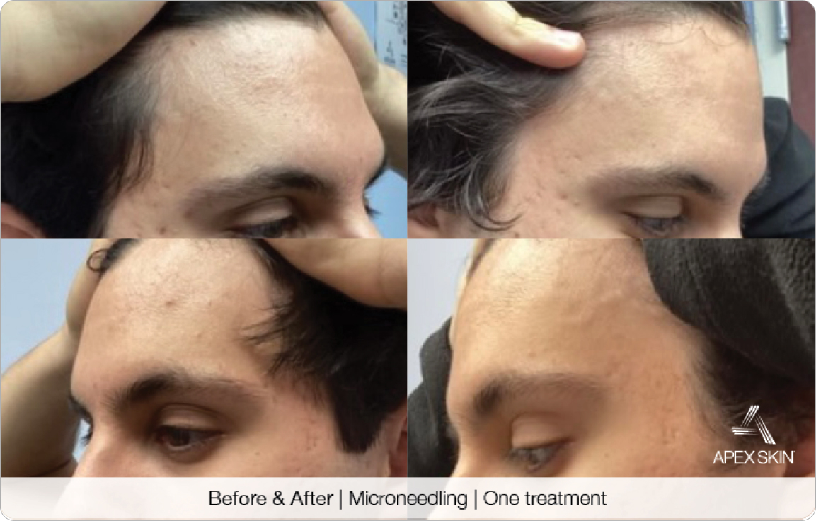 Microneedling - Before & After
