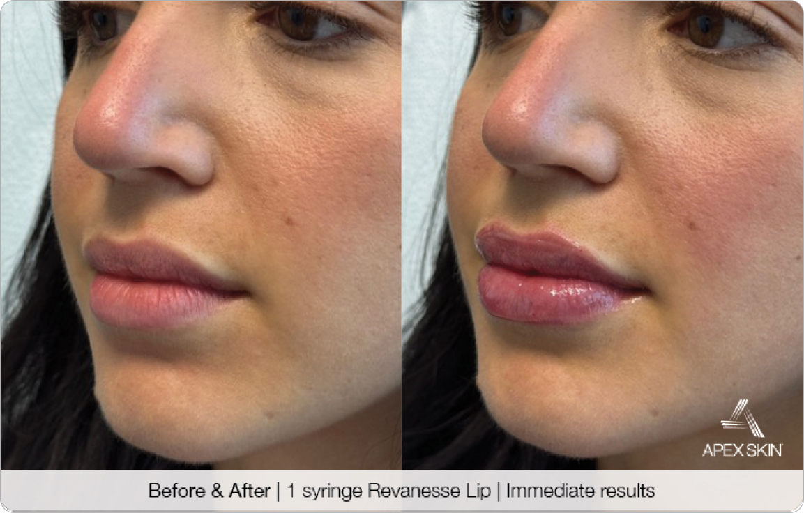 Syringe Revanesse Lip Before & After